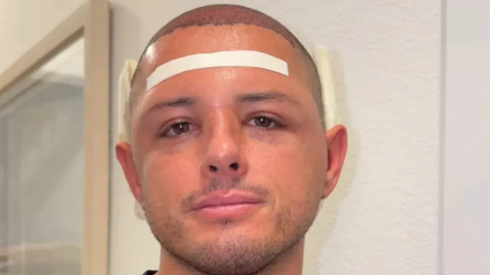 Javier 'Chicharito' Hernández sorprende en redes tras mostrar los avances de su tratamiento capilar