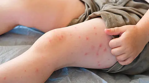 Los síntomas del sarampión suelen aparecer entre 7 y 14 días después del contagio, según especialistas de la UNAM./ Pixabay