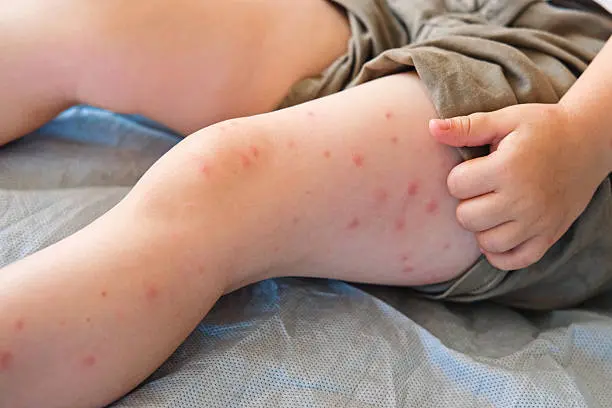 Los síntomas del sarampión suelen aparecer entre 7 y 14 días después del contagio, según especialistas de la UNAM./ Pixabay