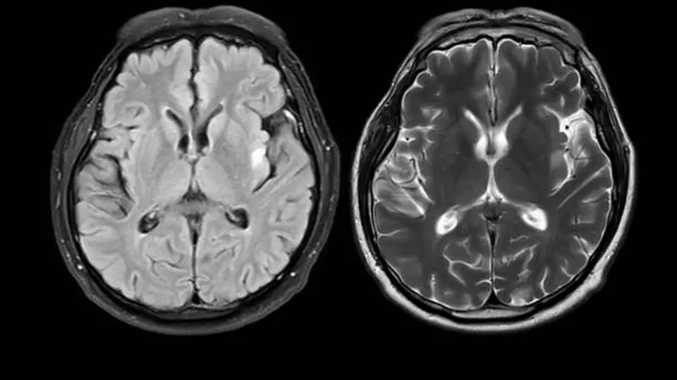 El Parkinson es una enfermedad neurodegenerativa que afecta el movimiento y la calidad de vida. / iStock
