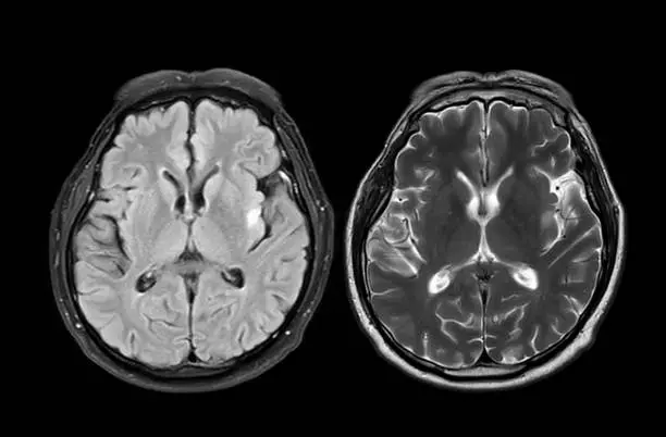 El Parkinson es una enfermedad neurodegenerativa que afecta el movimiento y la calidad de vida. / iStock