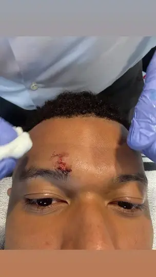 Herida de Mbappé |