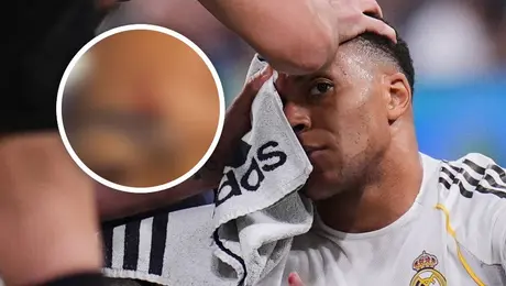 ¡Brutal! Así quedó la ceja de Mbappé tras codazo ante Girona
