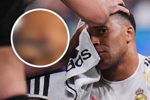 ¡Brutal! Así quedó la ceja de Mbappé tras codazo ante Girona