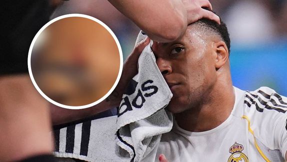 ¡Brutal! Así quedó la ceja de Mbappé tras codazo ante Girona