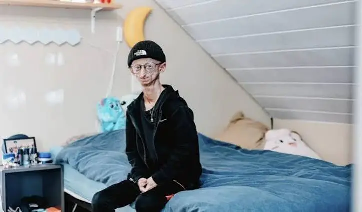 Michiel Vandeweert falleció a los 28 años después de desafiar durante años el pronóstico relacionado con la progeria./Especial