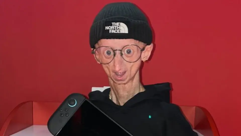 Michiel Vandeweert falleció a los 28 años después de desafiar durante años el pronóstico relacionado con la progeria./ Especial