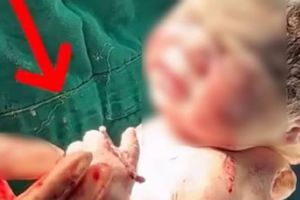 ¡Increíble! Bebé nace sosteniendo el DIU que debía evitar su embarazo