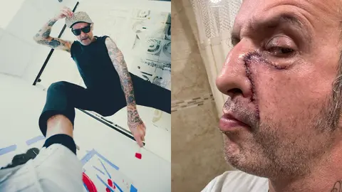 Tito de Molotov revela secuelas en su rostro: “Se me hizo mierd* la cara por drogadicto”