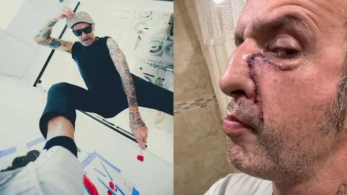 Tito de Molotov revela secuelas en su rostro: “Se me hizo mierd* la cara por drogadicto”
