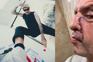 Tito de Molotov revela secuelas en su rostro: “Se me hizo mierd* la cara por drogadicto”