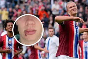 Haaland sufre accidente en autobus y comparte su herida con tres puntos de sutura