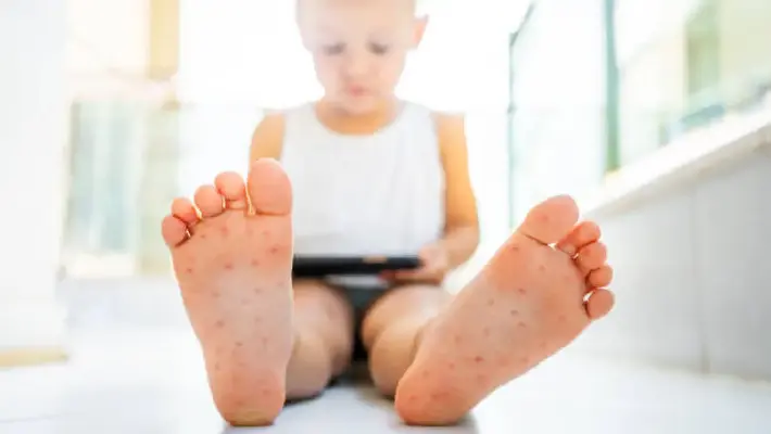 Alerta sanitaria: brote de virus Coxsackie afecta a niños en México