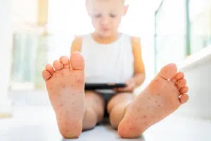 Alerta sanitaria: brote de virus Coxsackie afecta a niños en México