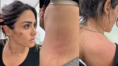 VIDEO: Alcaldesa de Cuauhtémoc acusa emboscada en operativo y muestra los golpes que recibió