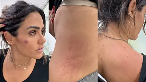 VIDEO: Alcaldesa de Cuauhtémoc acusa emboscada en operativo y muestra los golpes que recibió