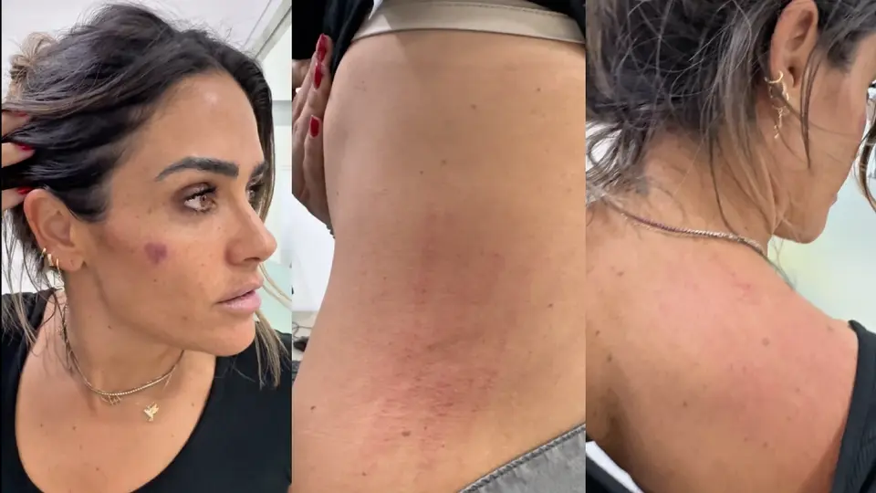 VIDEO: Alcaldesa de Cuauhtémoc acusa emboscada en operativo y muestra los golpes que recibió