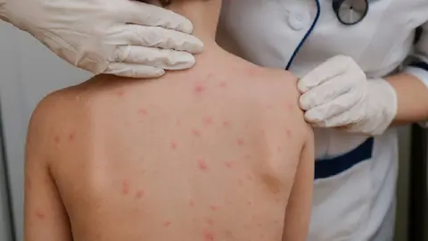México en alerta por aumento de casos de viruela símica y sarampión