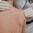México en alerta por aumento de casos de viruela símica y sarampión