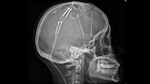 ¿Qué es la cirugía cerebral contra la depresión? El caso de Lorena Rodríguez en Colombia
