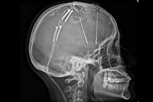 ¿Qué es la cirugía cerebral contra la depresión? El caso de Lorena Rodríguez en Colombia