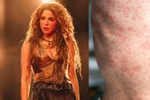 Asistentes al show de Shakira en riesgo por sarampión: autoridades piden precaución