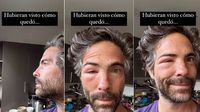 Actor Osvaldo Benavides aparece con el rostro desfigurado ¿Qué le pasó?