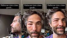 Actor Osvaldo Benavides aparece con el rostro desfigurado ¿Qué le pasó?