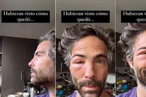 Actor Osvaldo Benavides aparece con el rostro desfigurado ¿Qué le pasó?