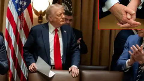 El misterioso moretón en la mano de Donald Trump: ¿qué hay detrás?