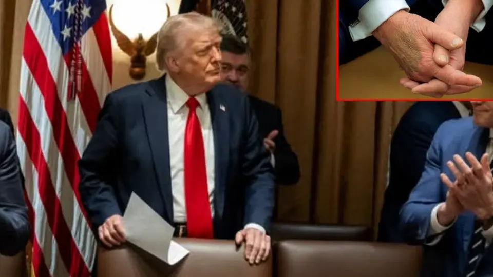 El misterioso moretón en la mano de Donald Trump: ¿qué hay detrás?