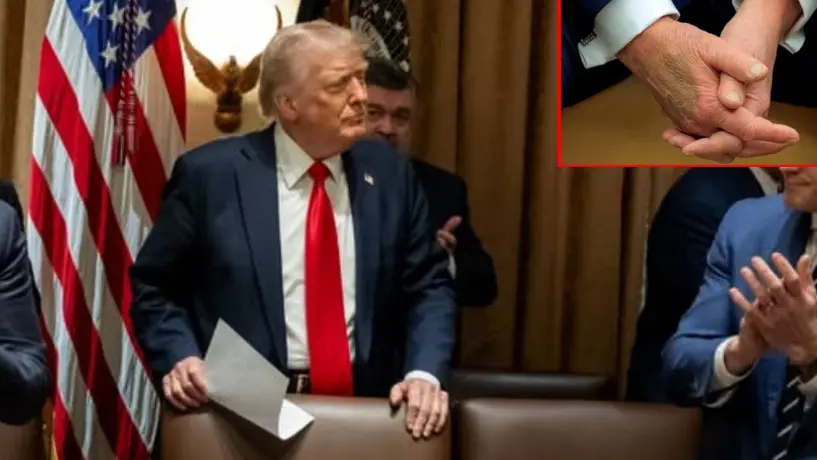 El misterioso moretón en la mano de Donald Trump: ¿qué hay detrás?