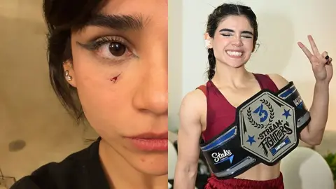 Alana preocupa a sus fans por moretón en el rostro: "Tuve un percance"