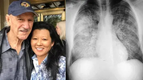 ¿Qué es el síndrome pulmonar por hantavirus? La causa de muerte de la esposa de Gene Hackman
