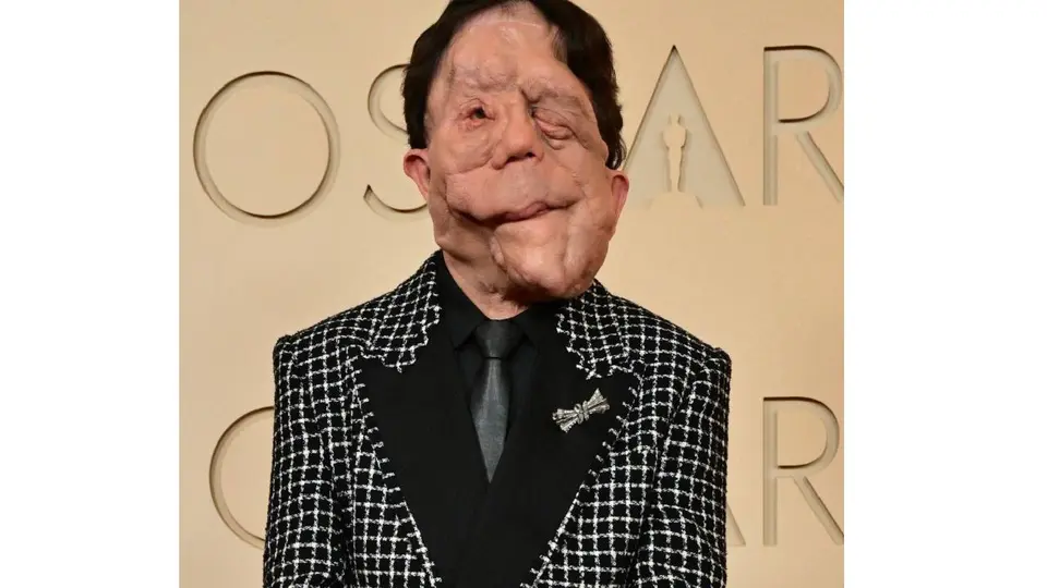 La presencia de Adam Pearson en los Oscar 2026 volvió a poner atención sobre esta condición poco común./ AFP