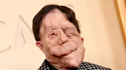 2026 Oscar: ¿Qué es la neurofibromatosis? La enfermedad que padece el actor Adam Pearson