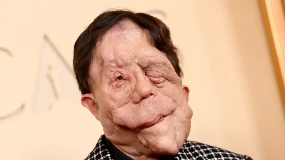 2026 Oscar: ¿Qué es la neurofibromatosis? La enfermedad que padece el actor Adam Pearson