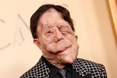 2026 Oscar: ¿Qué es la neurofibromatosis? La enfermedad que padece el actor Adam Pearson