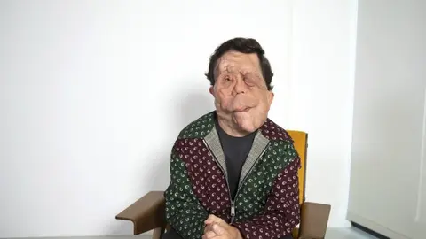 La neurofibromatosis tipo 1 provoca el crecimiento de tumores benignos en los nervios del cuerpo./ AP