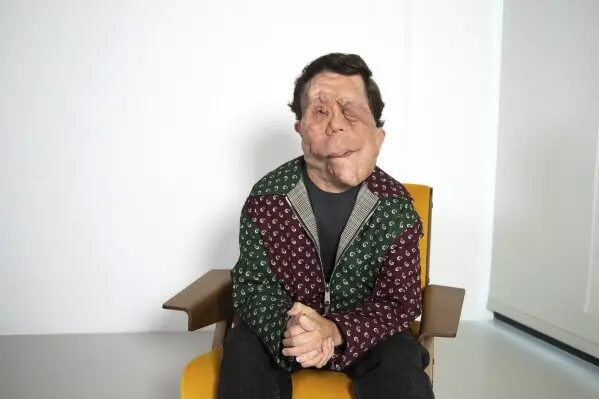 La neurofibromatosis tipo 1 provoca el crecimiento de tumores benignos en los nervios del cuerpo./ AP