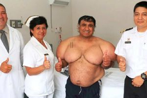 Conoce el caso de Alejandro Ramos, el buzo peruano que vive con el cuerpo 'inflado'