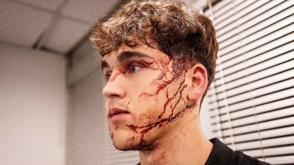 Pau Cubarsi tendrá que jugar con mascara protectora tras golpe en el rostro