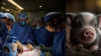 Trasplantan riñón de cerdo a humano ¡Ya van tres casos!