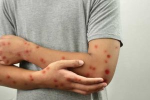 Estados Unidos confirma primer caso de la nueva cepa del mpox