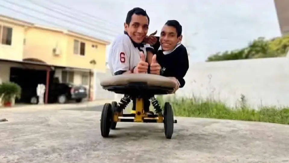 Los hermanos Cevallos estaban unidos por la pelvis y compartían el hígado y el intestino / Especial