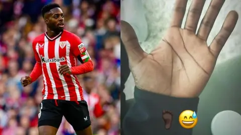 ¡De no creerse! Iñaki Williams jugó por dos años con un cristal enterrado en la planta del pie