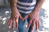 Suecia confirma su primer caso de viruela del mono (Mpox) fuera de África