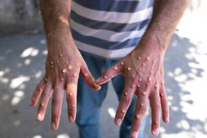 Suecia confirma su primer caso de viruela del mono (Mpox) fuera de África