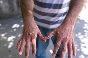 OMS está en alerta por nueva variante de la viruela del mono que se expande en África