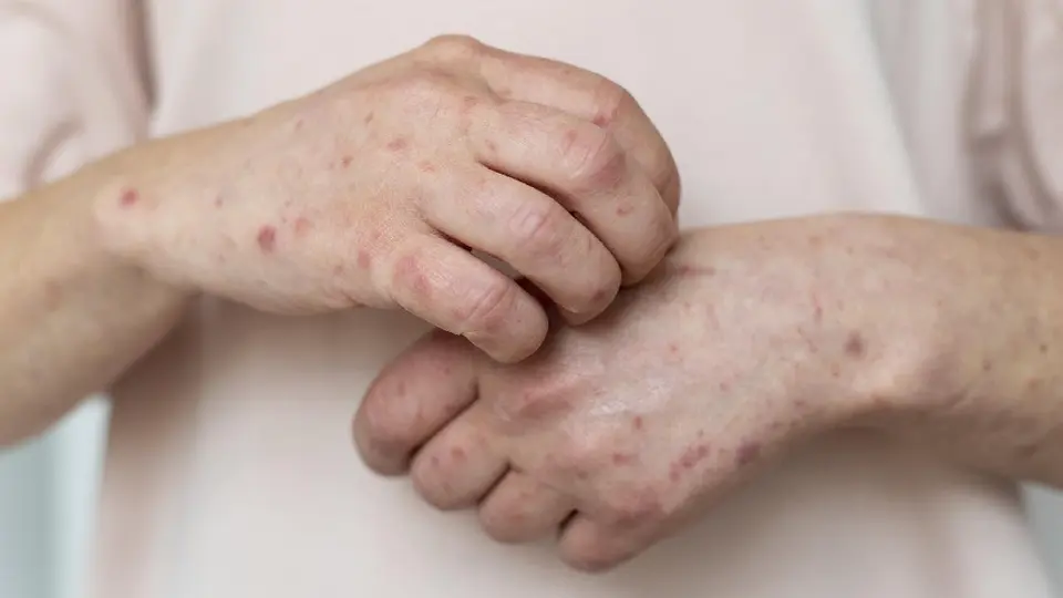¿Aumentan casos de sarampión? Llaman a la población a vacunarse